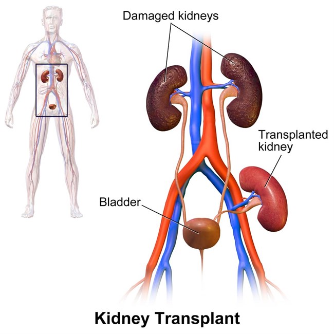 So Youre Thinking About Kidney Transplantation